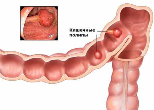 В случаях небольших полипов никаких клинических симптомов может не быть