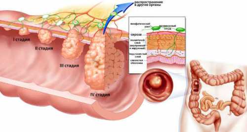 Причины полипов в кишечнике: диагноз, прогноз,