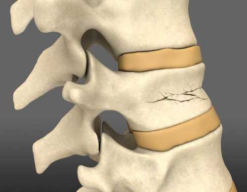 Компрессионный перелом позвоночника поясничного, грудного, шейного отдела