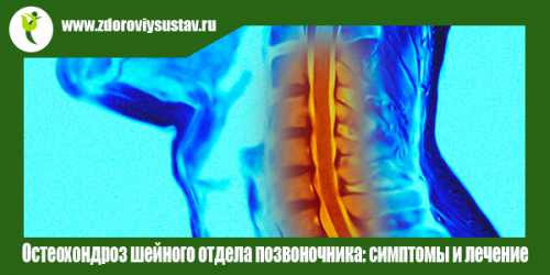 Более подробно о анальгетиках и какой список лекарств применяется при остеохондрозе позвоночника читайте здесь