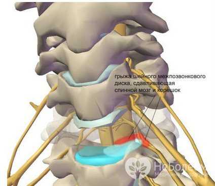 Остеохондроз шейного позвоночника: описание, симптомы, лечение