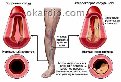 Атеросклероз: почему болеют сосуды