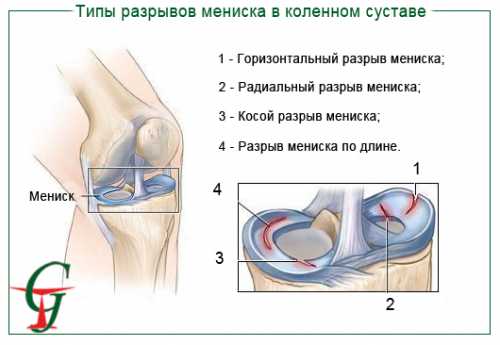 Разрыв мениска: что делать