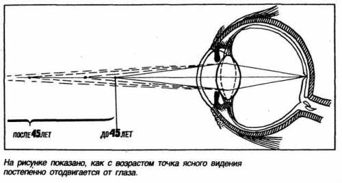 Поэтому для улучшения чёткости, расположенного на расстоянии изображения, человек начинает щуриться этот симптом близорукости заметил ещё