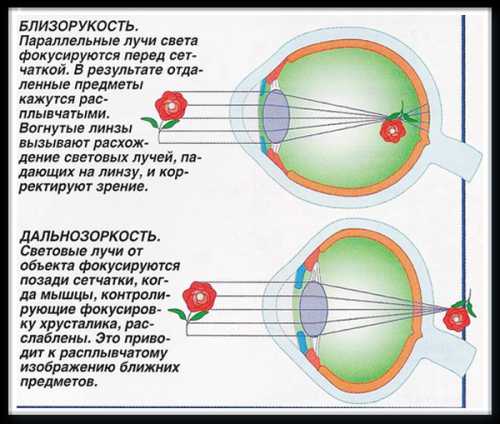 Дальнозоркость: описание, симптомы, лечение