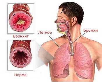 Бронхит: лечение медикаментозное, народными средствами, у взрослых